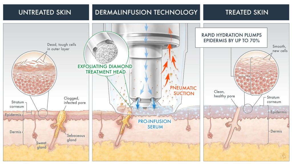 dermalinfusion